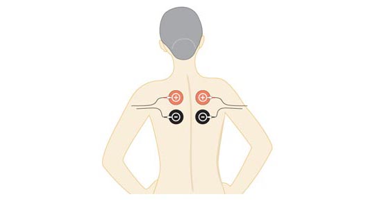 Tratamiento con electrodos