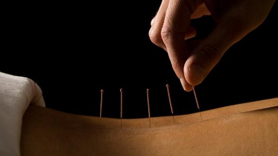 Mano aplicando acupuntura china sobre paciente